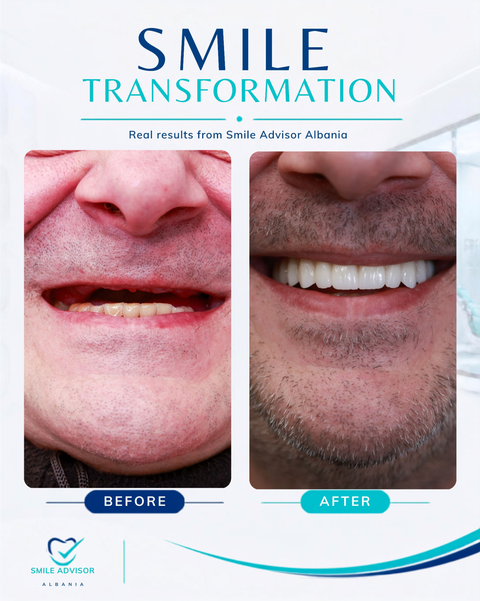Worn, discoloured upper teeth before treatment next to a bright, evenly restored smile after full-arch treatment