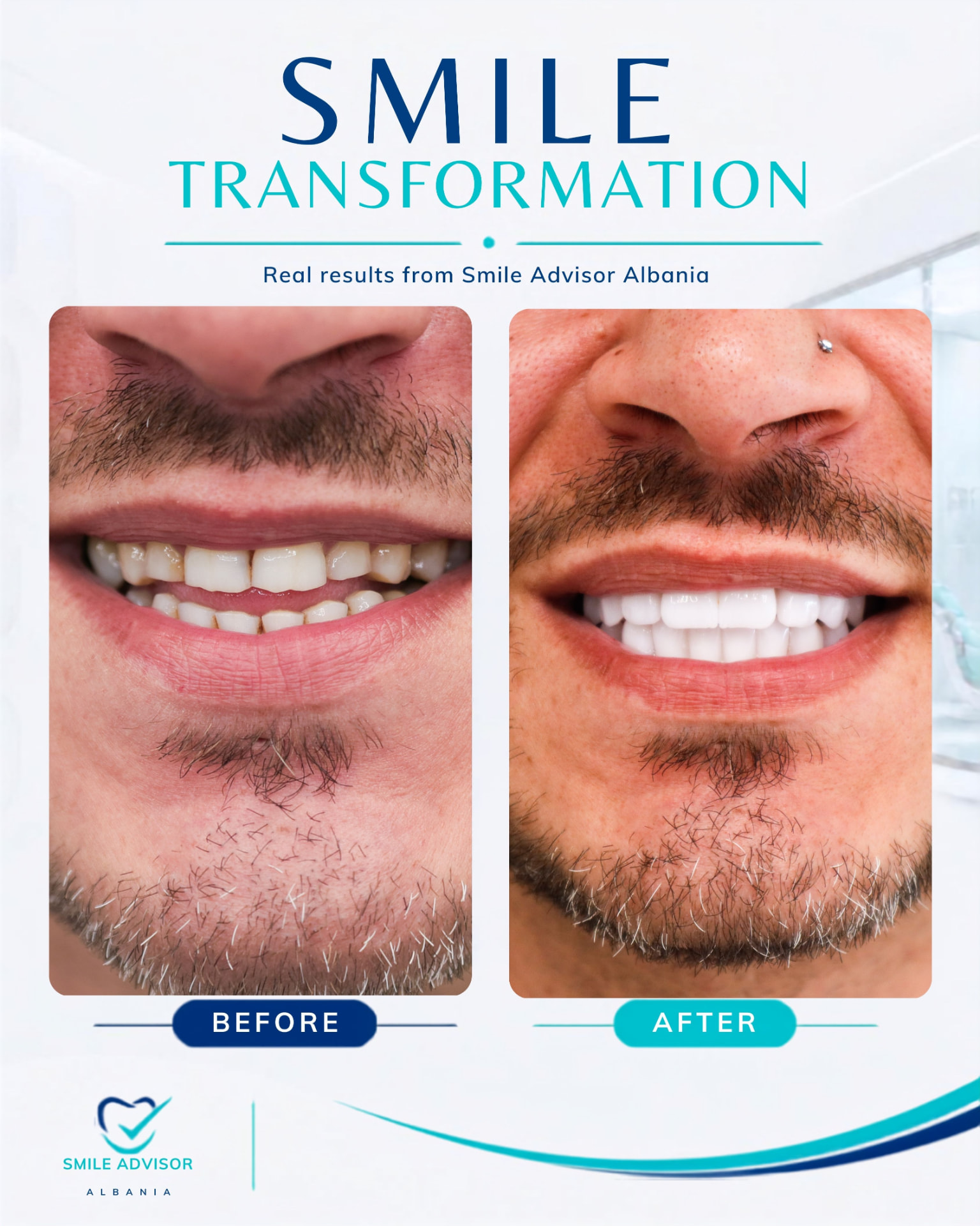 Uneven, discoloured teeth before treatment beside a bright, fully restored smile after treatment