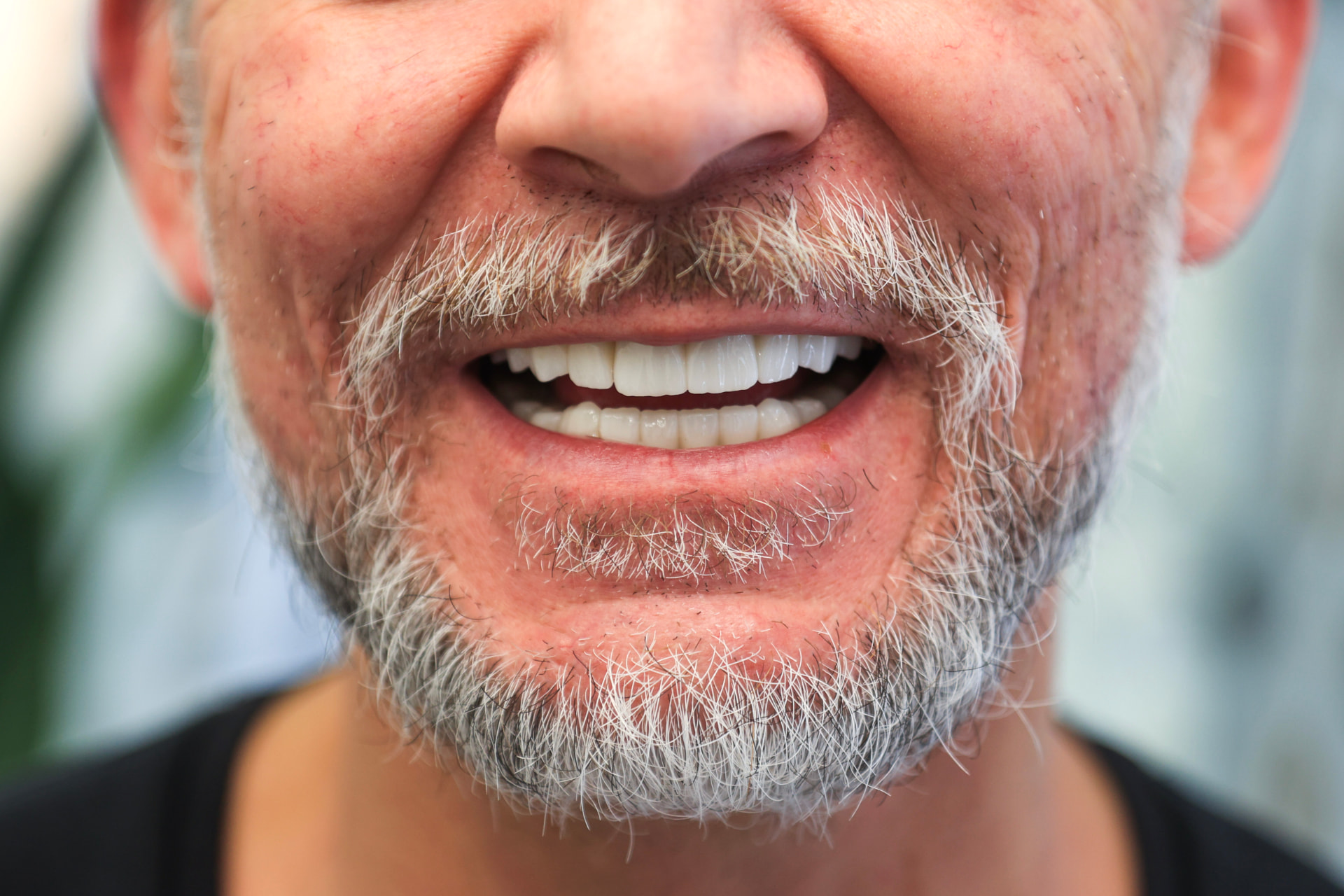 All-on-4 full-arch restoration — natural-looking fixed smile