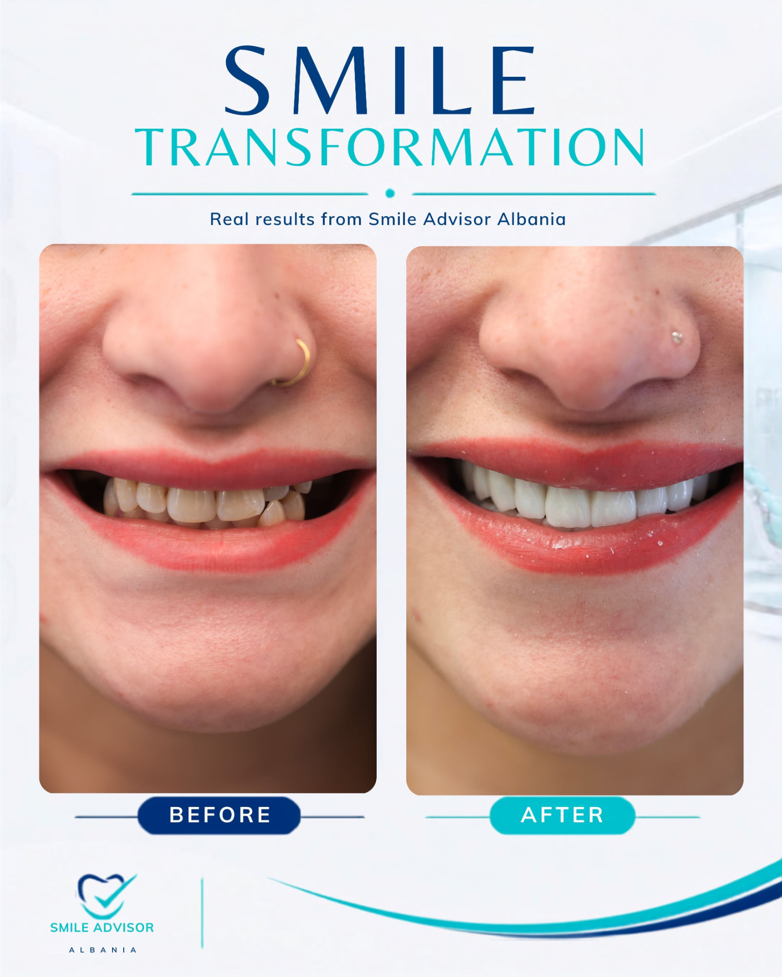Uneven, darkened teeth before treatment beside a bright, natural-looking smile after treatment