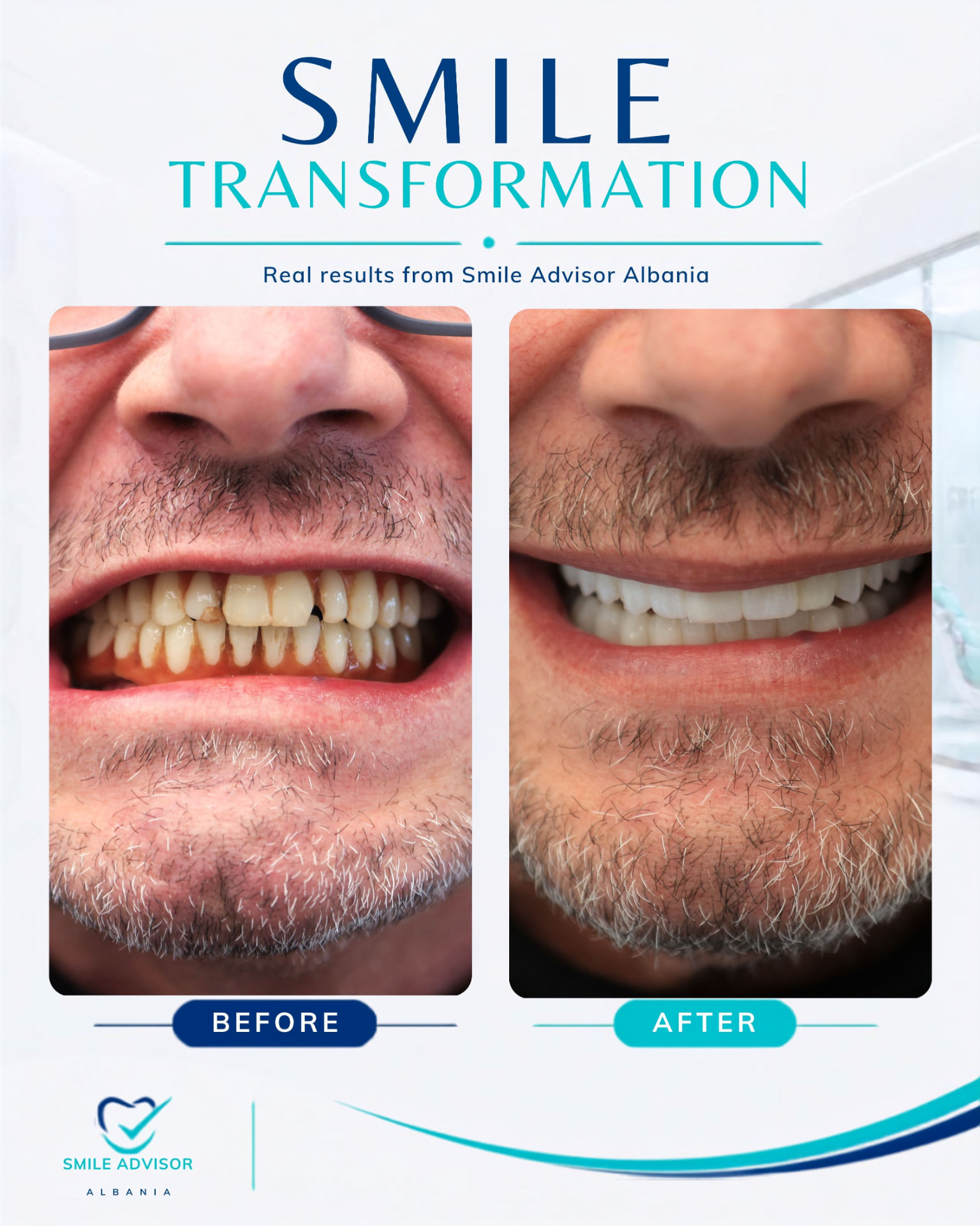 Worn and gapped teeth before treatment beside a bright, even smile after implant treatment